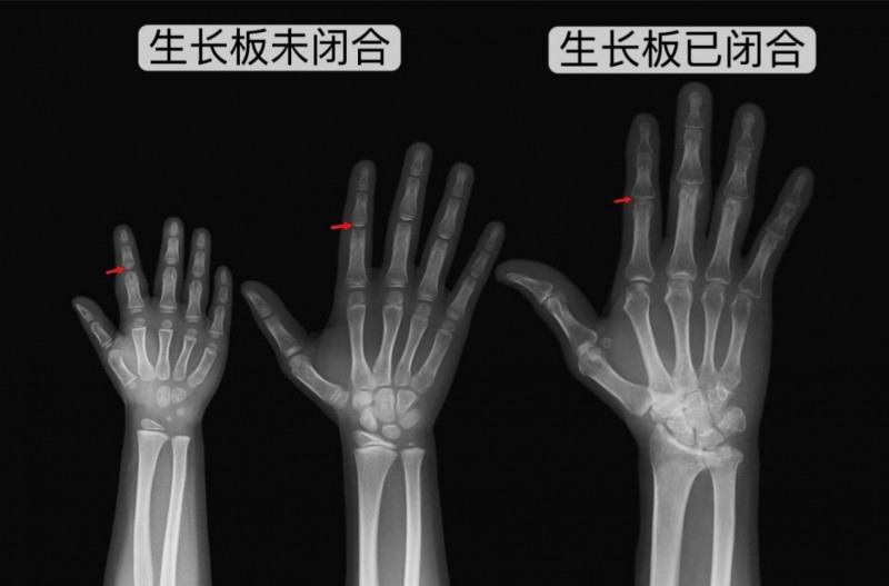 生长激素为矮小儿童带来新希望 香港儿科专科医生刘成志